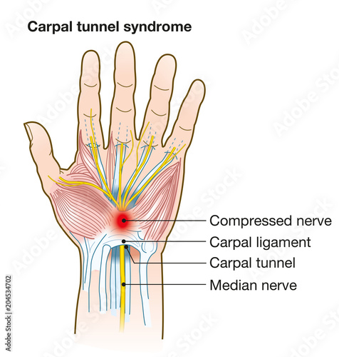 Carpal tunnel syndrome, anatomy, medical illustration with caption photo