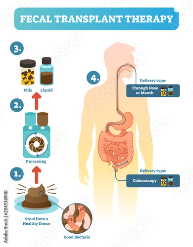 Fecal transplant therapy, procedure steps diagram, vector illustration. Renewing human digestive microflora.