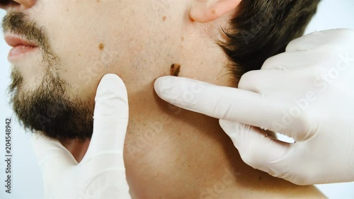 Doctor examine skin mole on person face close-up 4K photo
