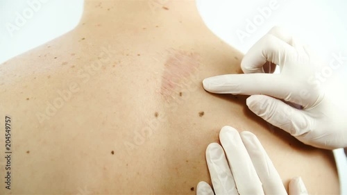 Specialists skin moles check-up 4K photo