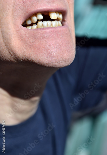 Foto mouth missing front tooth awaiting implant in senior male citizen
