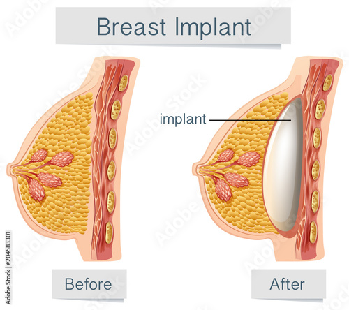 Human Anatomy of Breast Implant