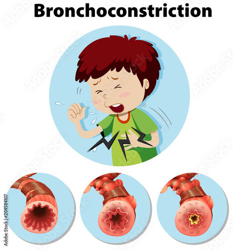 Human Anatomy Bronchoconstriction on White Background photo