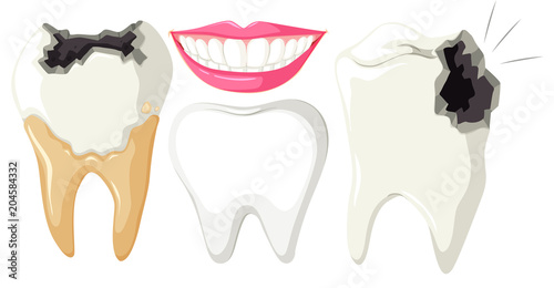 Tooth Decay on White Background