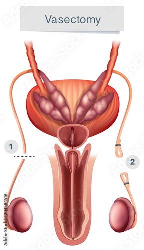 Human Anatomy of  Vasectomy on White Background