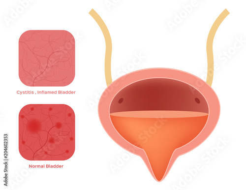 cystitis on bladder vector / infection  and inflammation