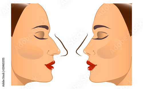 Rhinoplasty