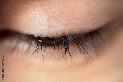 close up severe conjunctivitis from eyelash mites photo