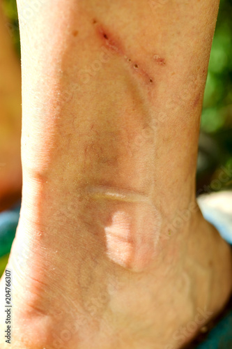 Dermis affected by varicose veins on the legs. © Dmytro Furman