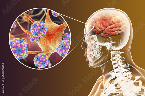 Encephalitis caused by enteroviruses, medical concept, 3D illustration showing brain infection and close-up view of neurons infected by viruses Coxsackie, Echo, Polio or other Picornaviruses photo