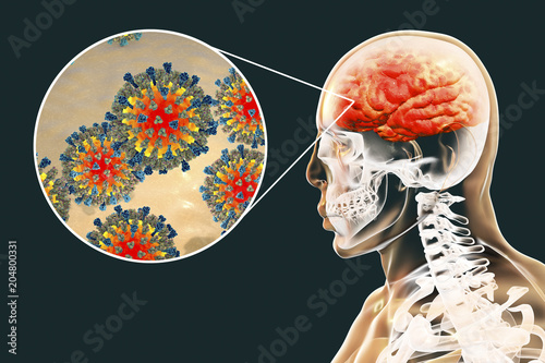 Measles-induced encephalitis, medical concept, 3D illustration showing brain infection and close-up view of Measles viruses photo