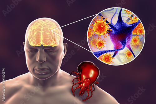 Tick-borne encephalitis concept, 3D illustration showing brain highlighted in human body, tick transmitting arboviruses and close-up view of neurons infected by viruses photo