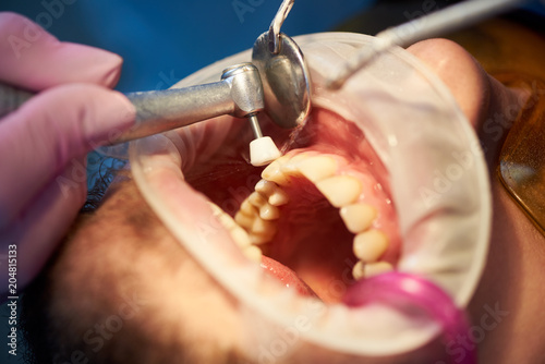 Closeup of a dental treatment where teeth are polished with a soft dental brush and cleaned with water.