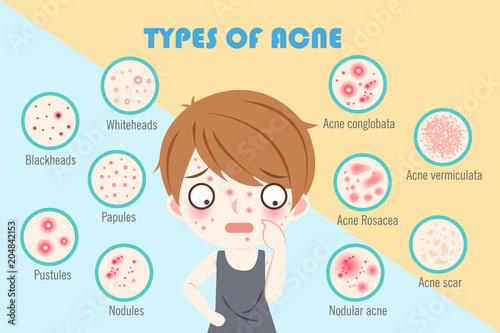 boy with types of acne