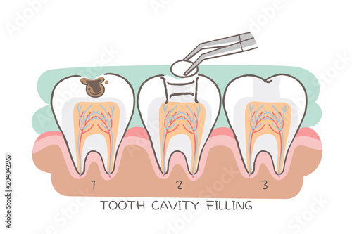 tooth cavity filling