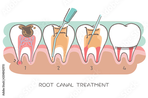 tooth with root canal treatment
