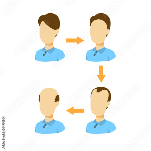 Stages of baldness.