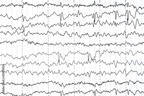 Abnormal EEG  brain wave photo