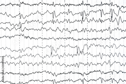 Abnormal EEG  brain wave