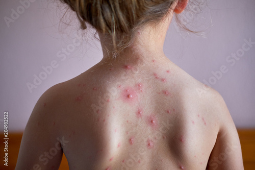 Little girl with a chickenpox on her back