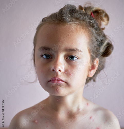 Obraz na plátně Portrait of a lovely 6 years old little girl with chickenpox