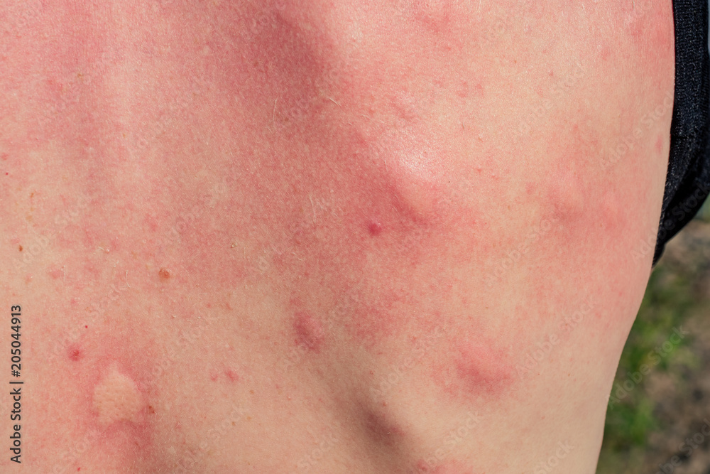 a man's back bite of a mosquito on the background of a mall