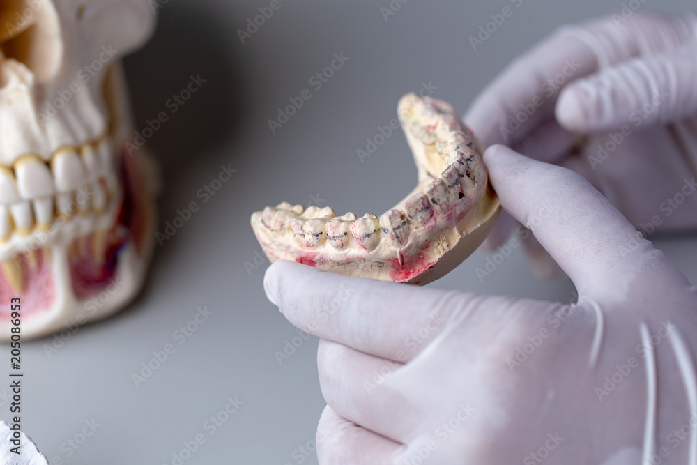 Study cast of Diagnostic cast and dental gypsum models in dental