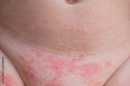 Tableau sur toile Yeast diaper rash and dermatitis on the belly of a newborn baby