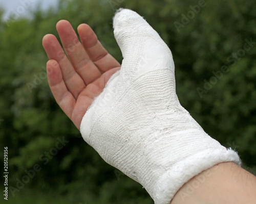 hand of the injured person after the fracture of the thumb phala photo