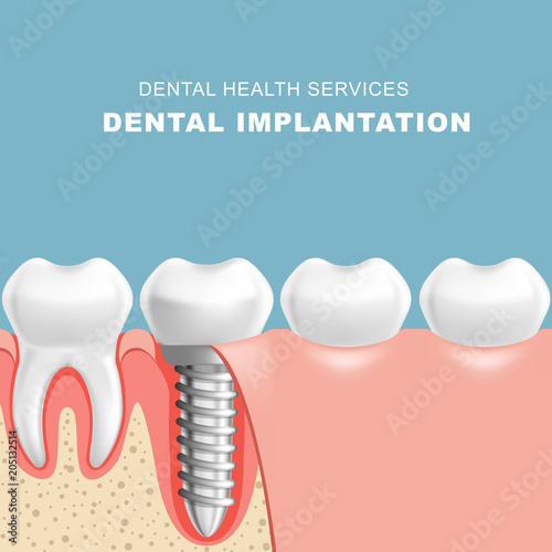 Gum section with dental implantat - row of teeth