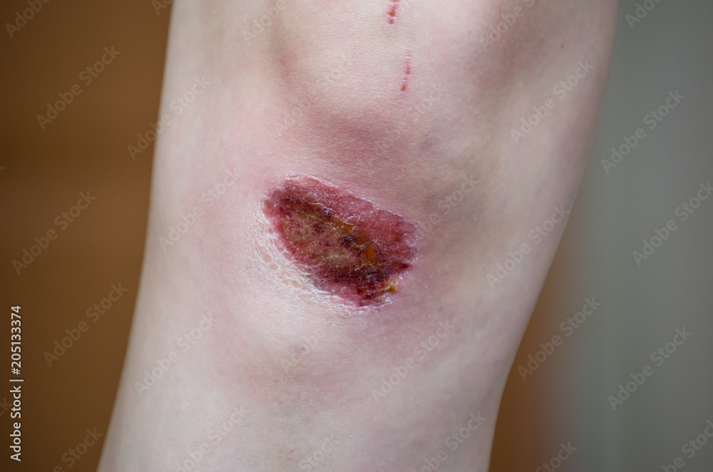 Fototapeta premium abrasion on the knee of a girl