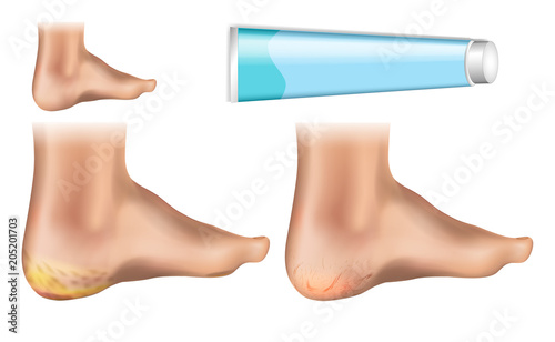 
Vector illustration of Plantar Hyperkeratosis of the foot with dry sole skin and cracked heel. Skin diseases, heel cracks, cracks in the heels of people, medical poster