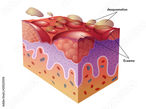 vector medical illustration of the symptoms of eczema photo