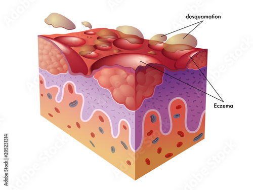 vector medical illustration of the symptoms of eczema