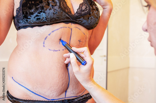 surgeon preparing woman for liposuction surgery photo