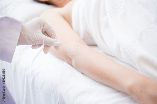 Therapy of female arm with pricking acupuncture needle