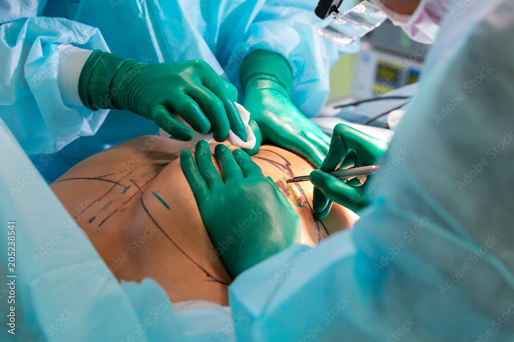 Surgeons team working with patient. breast augmentation Surgeons team working with patient. breast augmentation