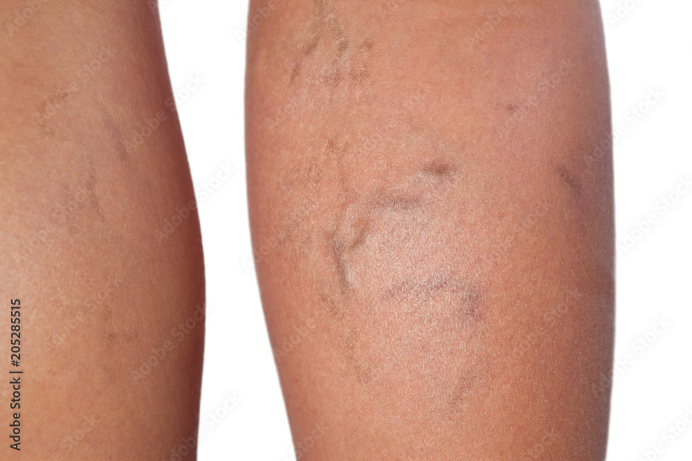 Spider veins close up.Varicose veins. Spider veins close up.Varicose veins.