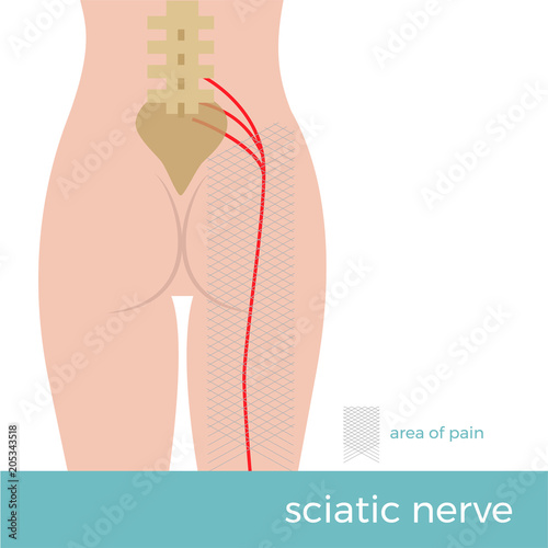 sciatic nerve anatomy. illustration showing the schematic course of the nerve and the place where the pain arises. sciatica 