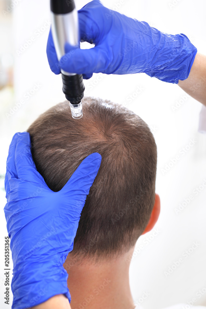 Fototapeta premium Mezoterapia mikroigłowa skóry głowy. Głowa mężczyzny z przerzedzonymi włosami podczas zabiegu mezoterapii igłowej