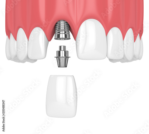 3d render of upper jaw with teeth and dental incisor implant photo