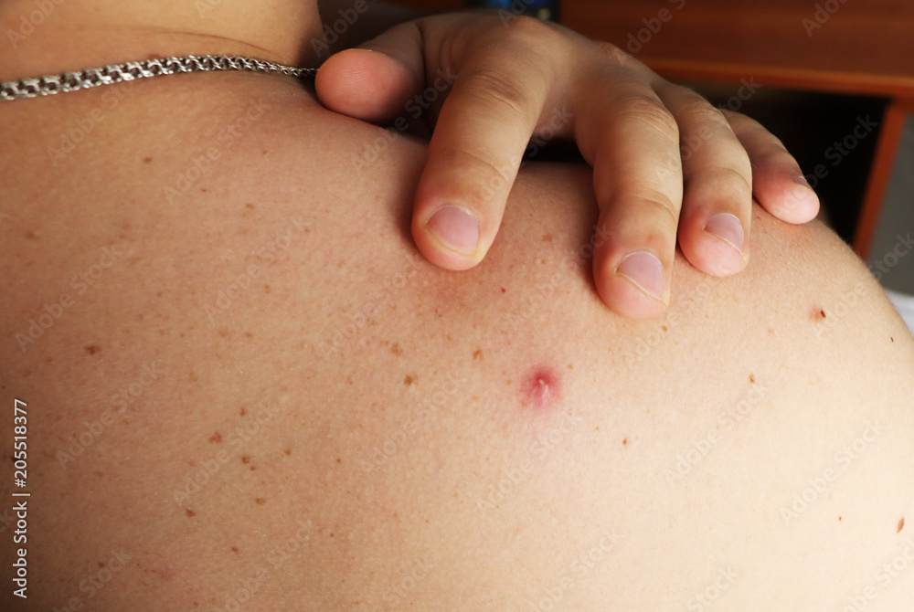 Photo of a pimple with pus on the back of a man Photo of a pimple with pus on the back of a man