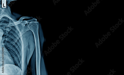 x-ray shoulder and part of rib and lung, banner x-ray