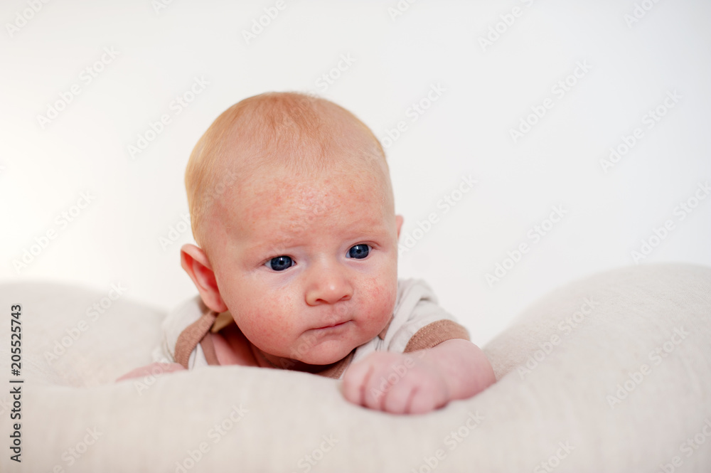 Allergies, atopic dermatitis on the face of a baby Allergies, atopic dermatitis on the face of a baby