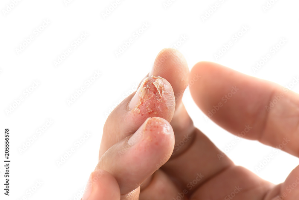 Skin allergy.Advanced stage of dyshidrosis on fingers,cracked and
