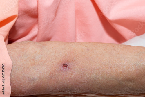 Scab. A wound form a scab on an arm of elderly patient. photo
