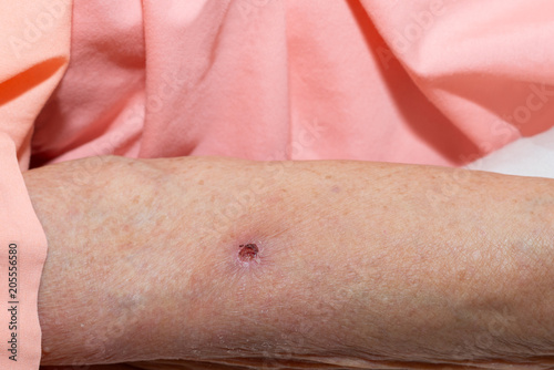 Scab. A wound form a scab on an arm of elderly patient.