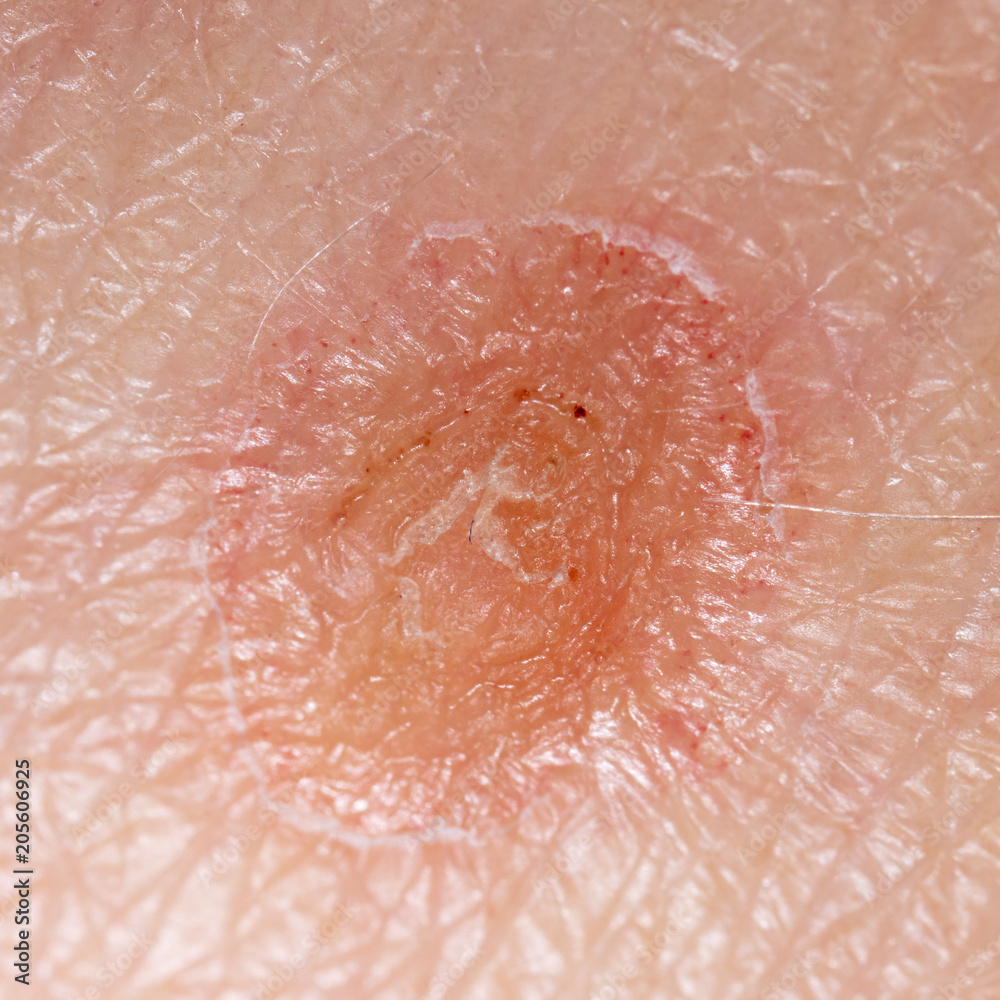 Ringworm on the human skin as a background Ringworm on the human skin as a background
