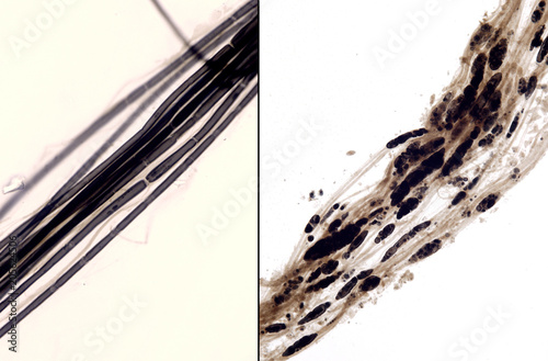 Myelinated nerve fibers. Wallerian degeneration photo