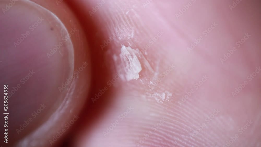 Feeling callosity on palm macro focus